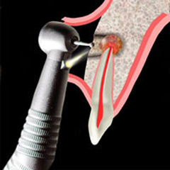 Rezectie apicala post tratament endodontic cu depasire