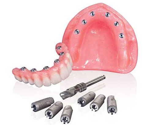 Implant dentar vs Proteza dentara
