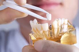 Stabilirea diagnosticului si planificarea secventelor de tratament in implantologia orala