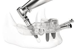 Pozitia implantelor dentare