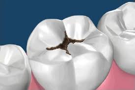 Cariile dentare – preventie si tratament