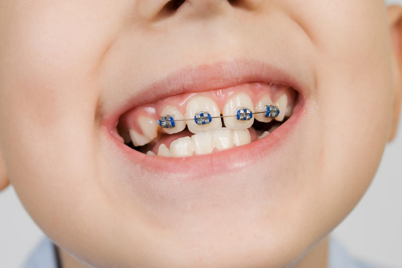 Correctly Mittens tooth Aparat ortodontic copii | Chirurgie Orala